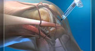 Iniezione ortopedica dei prodotti &amp; iniezione del ginocchio dell'acido ialuronico dello strumento di puntura